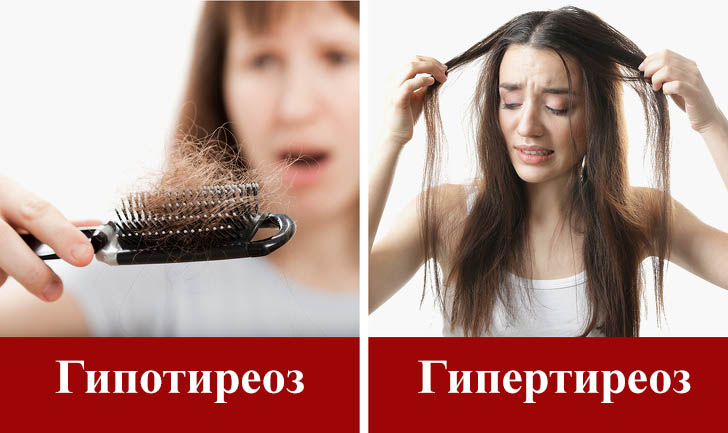 Выпадение волос