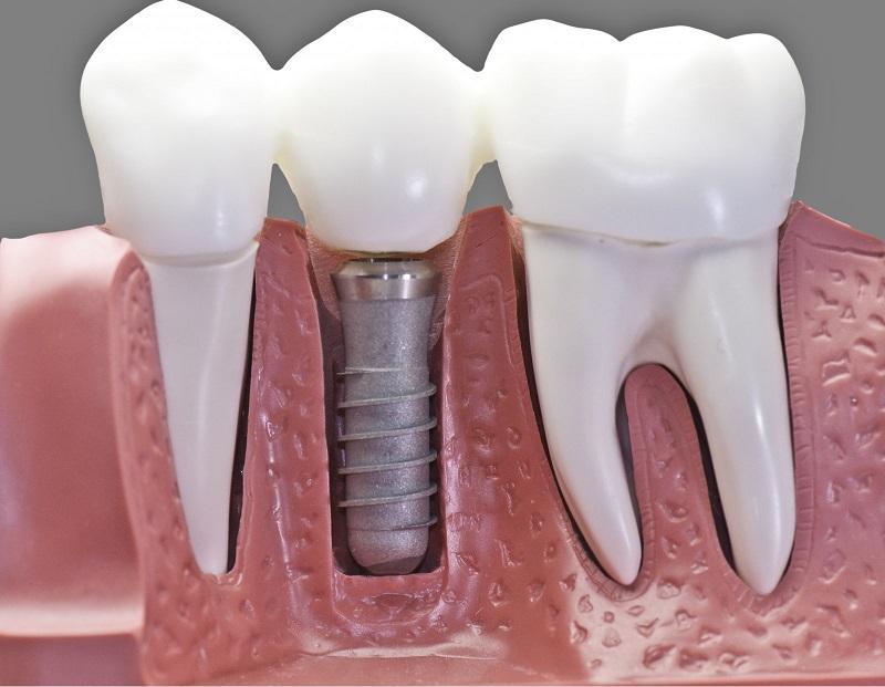 Маска для зубов, которая оставит стоматологов без работы! Всего 4 компонента!